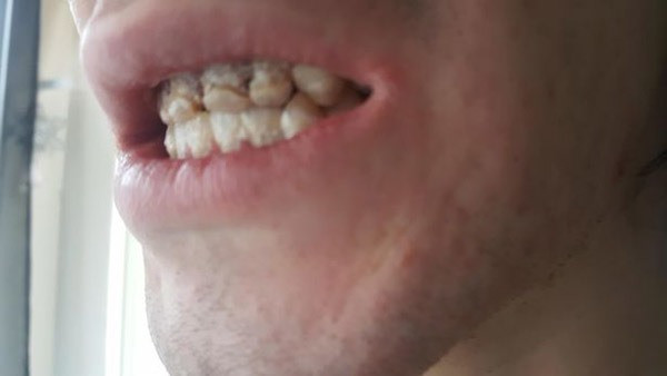 Cận cảnh hiện tượng lưỡi bị ăn mòn nghiêm trọng do nước tăng lực